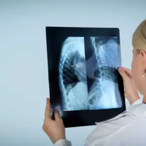 Imagem representativa: Escoliose O Impacto na Postura e a Importância do Tratamento Fisioterapêutico